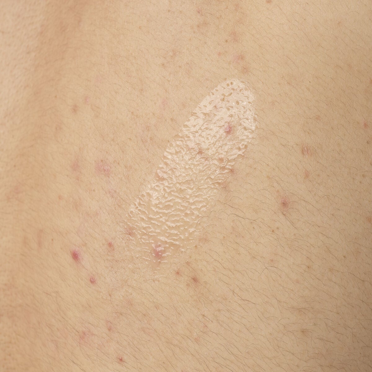 salicylic-acid-0-5-body-serum-i5 ORD-salicylic-acid-05-body-240ml-application.jpg