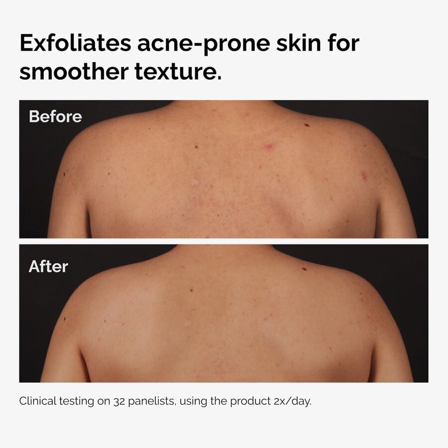 salicylic-acid-0-5-body-serum-i5 ord-salicylic-acid-body-serum-before-after-graphic-NA.jpg